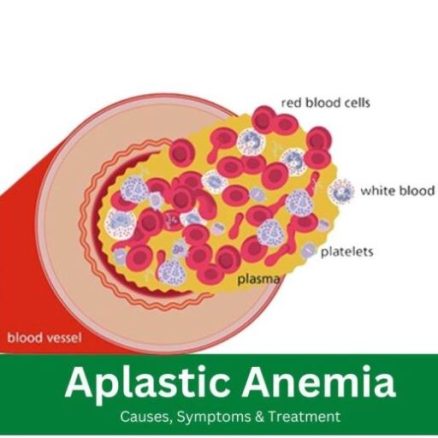Aplastic-Anemia